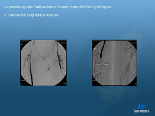 Isquemia aguda: Indicaciones Tratamiento M édico-Quirúrgico 1. CAUSA DE ISQUEMIA AGUDA 