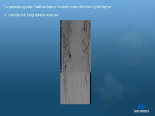 Isquemia aguda: Indicaciones Tratamiento M édico-Quirúrgico 1. CAUSA DE ISQUEMIA AGUDA 