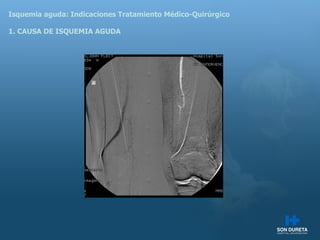Isquemia aguda: Indicaciones Tratamiento M édico-Quirúrgico 1. CAUSA DE ISQUEMIA AGUDA 