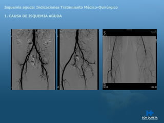 Isquemia aguda: Indicaciones Tratamiento M édico-Quirúrgico 1. CAUSA DE ISQUEMIA AGUDA 