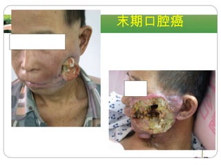 9.02 末期口腔癌 