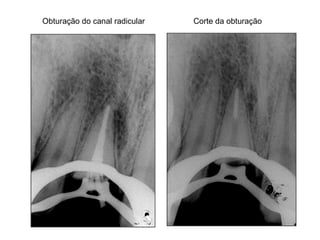 Corte da obturação Obturação do canal radicular 
