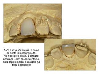 Após a extrusão da raiz, a coroa do dente foi descongelada. No modelo de gesso, a coroa foi adaptada , com desgaste interno, para depois realizar a colagem na boca do paciente 