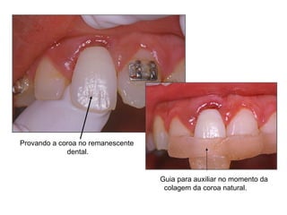 Provando a coroa no remanescente  dental. Guia para auxiliar no momento da colagem da coroa natural. 