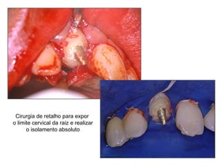 Cirurgia de retalho para expor o limite cervical da raiz e realizar o isolamento absoluto 