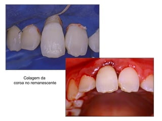 Colagem da  coroa no remanescente 