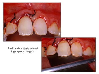 Realizando a ajuste oclusal logo após a colagem 