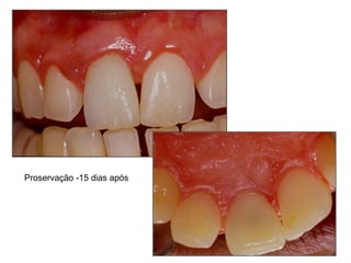 Proservação -15 dias após 