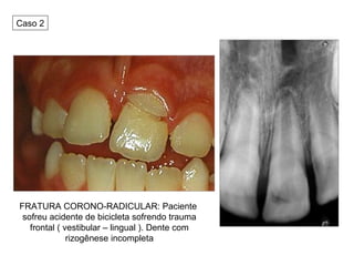 FRATURA CORONO-RADICULAR: Paciente sofreu acidente de bicicleta sofrendo trauma frontal ( vestibular – lingual ). Dente com rizogênese incompleta Caso 2 