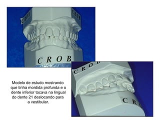 Modelo de estudo mostrando que tinha mordida profunda e o dente inferior tocava na lingual do dente 21 deslocando para  a vestibular. 