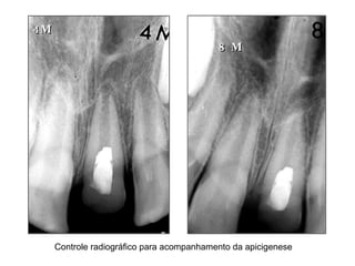 4M 8 M Controle radiográfico para acompanhamento da apicigenese 