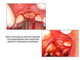 Após a formação do ápice foi realizado uma gengivoplastia para isolamento absoluto e tratamento endodôntico. 