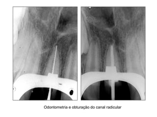 Odontometria e obturação do canal radicular 