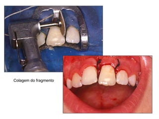 Colagem do fragmento 