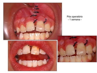 Pós operatório - 1 semana - 