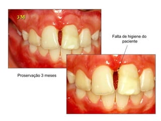 3M Falta de higiene do paciente Proservação 3 meses 
