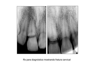 Rx para diagnóstico mostrando fratura cervical 