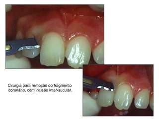 Cirurgia para remoção do fragmento coronário, com incisão inter-sucular. 