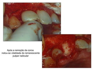 Após a remoção da coroa  notou-se vitalidade do remanescente pulpar radicular 