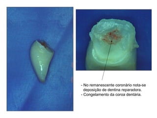 - No remanescente coronário nota-se deposição de dentina reparadora. - Congelamento da coroa dentária. 