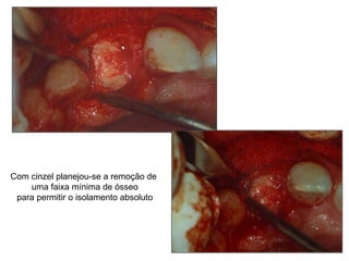 Com cinzel planejou-se a remoção de uma faixa mínima de ósseo para permitir o isolamento absoluto 