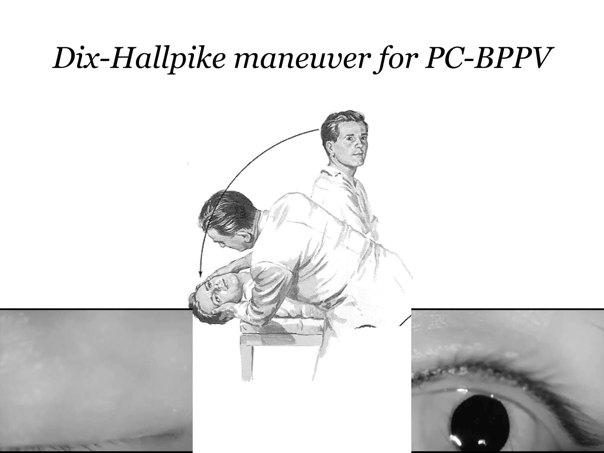 Dix-Hallpike maneuver for PC-BPPV
 