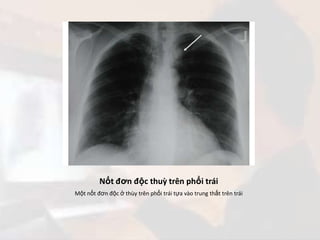 Nốt đơn độc thuỳ trên phổi trái<br />Một nốt đơn độc ở thùy trên phổi trái tựa vào trung thất trên trái<br />