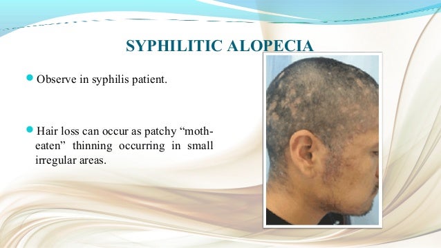 Alopecia