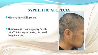 SYPHILITIC ALOPECIA
Observe in syphilis patient.
Hair loss can occur as patchy “moth-
eaten” thinning occurring in small
irregular areas.
 