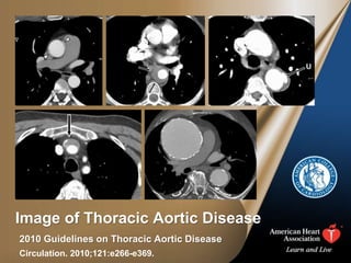 Image of Thoracic Aortic Disease
Circulation. 2010;121:e266-e369.
2010 Guidelines on Thoracic Aortic Disease
 
