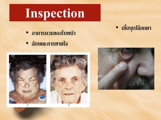Inspection
• อาการบวมของใบหนา
• ลักษณะการหายใจ
• เยื่อบุเปลือกตา
 