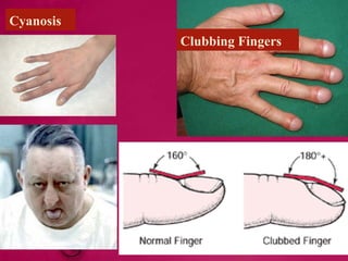 Clubbing Fingers
Cyanosis
 
