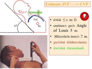 Estimate JVP - - -> CVP
• คาปกติ ≤ 8 ซม. น้ํา
• เอเตรียมขวา สูงกวา Angle
of Louis 5 ซม.
• ใชไมบรรทัดวัด นอยกวา .?. ซม.
• สูงกวาปกติ หัวใจซีกขวาลมเหลว
• ต่ํากวาปกติ ปริมาตรเลือดต่ํา
 