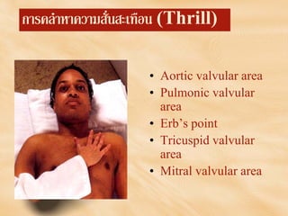 การคลําหาความสั่นสะเทือน (Thrill)
• Aortic valvular area
• Pulmonic valvular
area
• Erb’s point
• Tricuspid valvular
area
• Mitral valvular area
 