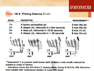 อาการบวม
 