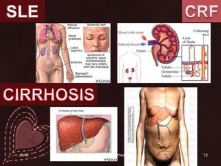 12SLECRFCIRRHOSIS14 June 2010Rangsima Poomsawat
