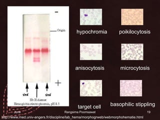 19hypochromiapoikilocytosisanisocytosismicrocytosisbasophilic stipplingtarget cell http://www.med.univ-angers.fr/discipline/lab_hema/morphogrweb/webmorphohematie.html14 June 2010Rangsima Poomsawat