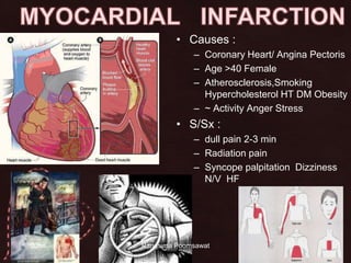 28MYOCARDIAL   INFARCTIONCauses : Coronary Heart/ Angina PectorisAge >40 FemaleAtherosclerosis,SmokingHypercholesterol HT DM Obesity~ Activity Anger StressS/Sx : dull pain 2-3 minRadiation painSyncope palpitation  Dizziness N/V  HF14 June 2010Rangsima Poomsawat