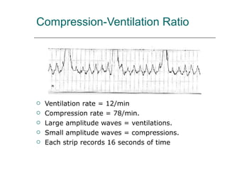 Compression-Ventilation Ratio Ventilation rate = 12/min Compression rate = 78/min. Large amplitude waves = ventilations. Small amplitude waves = compressions. Each strip records 16 seconds of time 