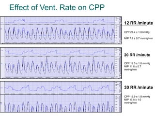 Effect of Vent. Rate on CPP 12 RR /minute CPP 23.4 ± 1.0mmHg MIP 7.1 ± 0.7 mmHg/min 20 RR /minute CPP 19.5 ± 1.8 mmHg MIP 11.6 ± 0.7 mmHg/min 30 RR /minute CPP 16.9 ± 1.8 mmHg MIP 17.5 ± 1.0 mmHg/min 
