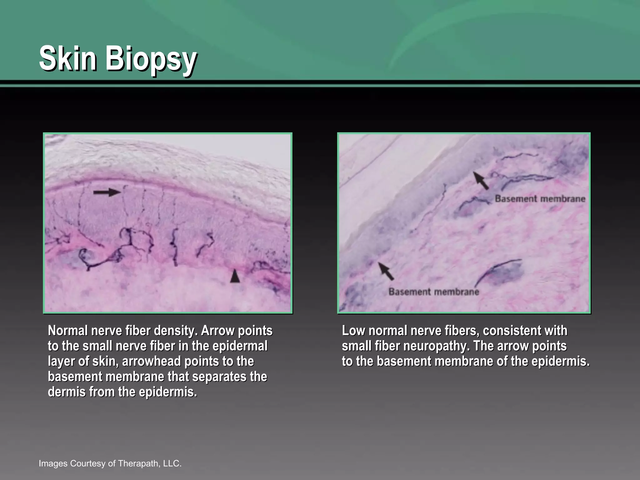 Skin Biopsy Normal nerve fiber density. Arrow points to the small nerve fiber in the epidermal layer of skin, arrowhead points to the basement membrane that separates the dermis from the epidermis.  Low normal nerve fibers, consistent with small fiber neuropathy. The arrow points to the basement membrane of the epidermis.  Images Courtesy of Therapath, LLC. 