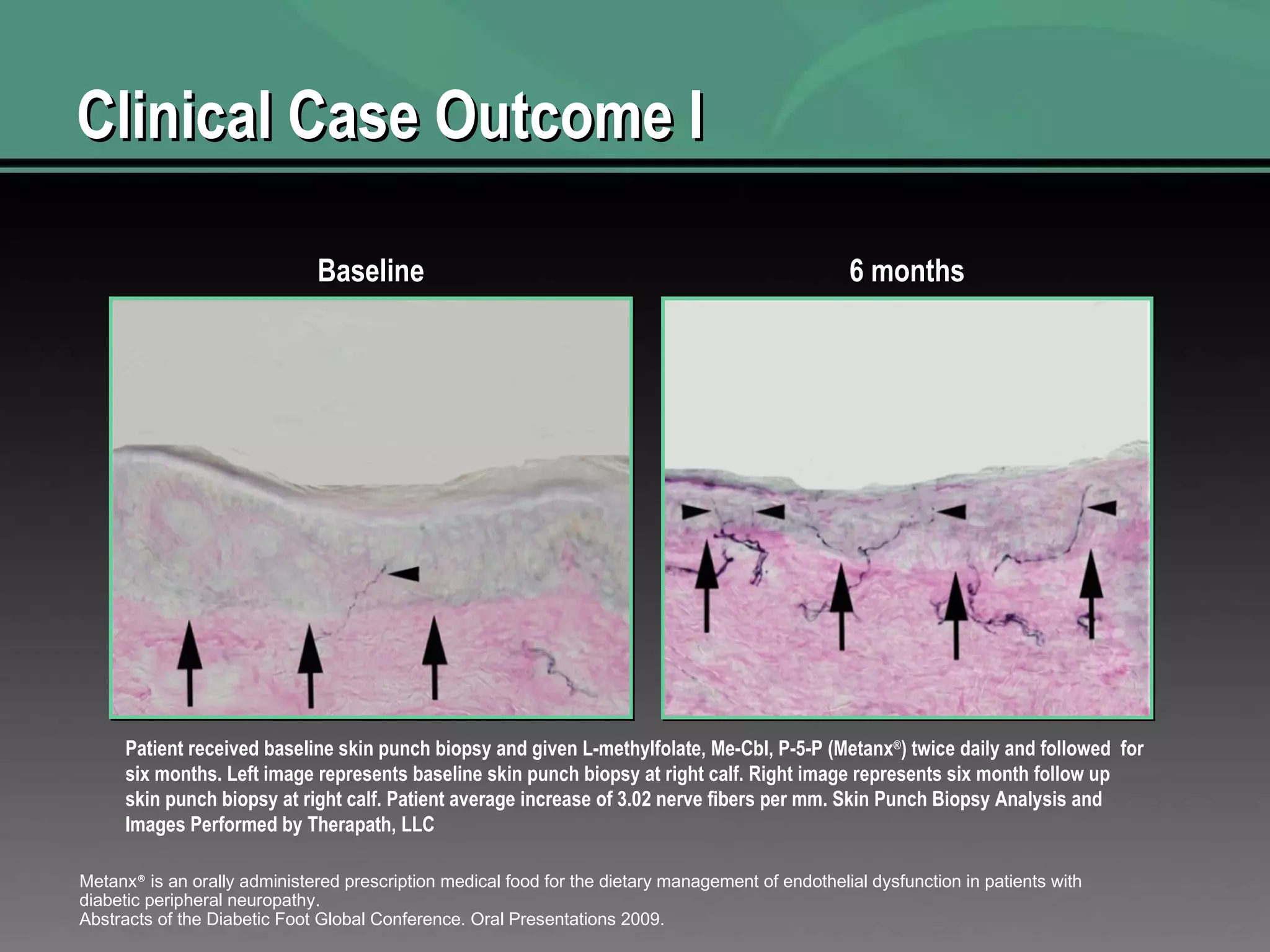 Clinical Case Outcome I Baseline 6 months Patient received baseline skin punch biopsy and given L-methylfolate, Me-Cbl, P-5-P (Metanx ® ) twice daily and followed  for six months. Left image represents baseline skin punch biopsy at right calf. Right image represents six month follow up skin punch biopsy at right calf. Patient average increase of 3.02 nerve fibers per mm. Skin Punch Biopsy Analysis and Images Performed by Therapath, LLC Metanx ®  is an orally administered prescription medical food for the dietary management of endothelial dysfunction in patients with diabetic peripheral neuropathy. Abstracts of the Diabetic Foot Global Conference. Oral Presentations 2009.  