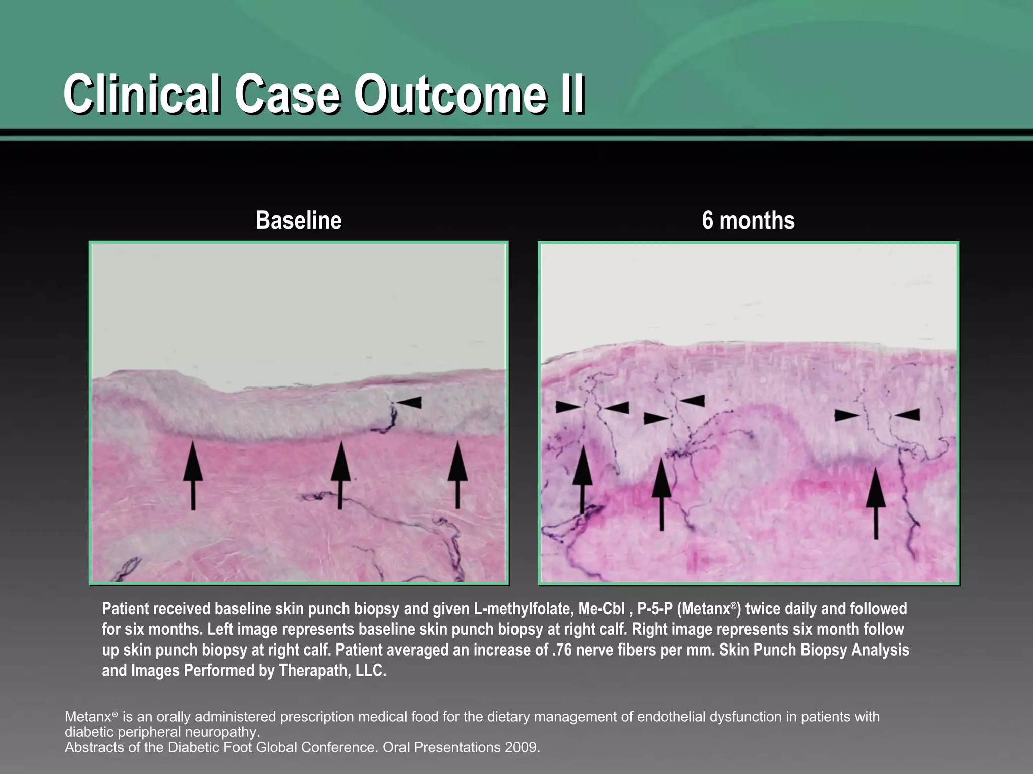Clinical Case Outcome II Patient received baseline skin punch biopsy and given L-methylfolate, Me-Cbl , P-5-P (Metanx ® ) twice daily and followed for six months. Left image represents baseline skin punch biopsy at right calf. Right image represents six month follow up skin punch biopsy at right calf. Patient averaged an increase of .76 nerve fibers per mm. Skin Punch Biopsy Analysis and Images Performed by Therapath, LLC. Baseline 6 months Metanx ®  is an orally administered prescription medical food for the dietary management of endothelial dysfunction in patients with diabetic peripheral neuropathy. Abstracts of the Diabetic Foot Global Conference. Oral Presentations 2009.  