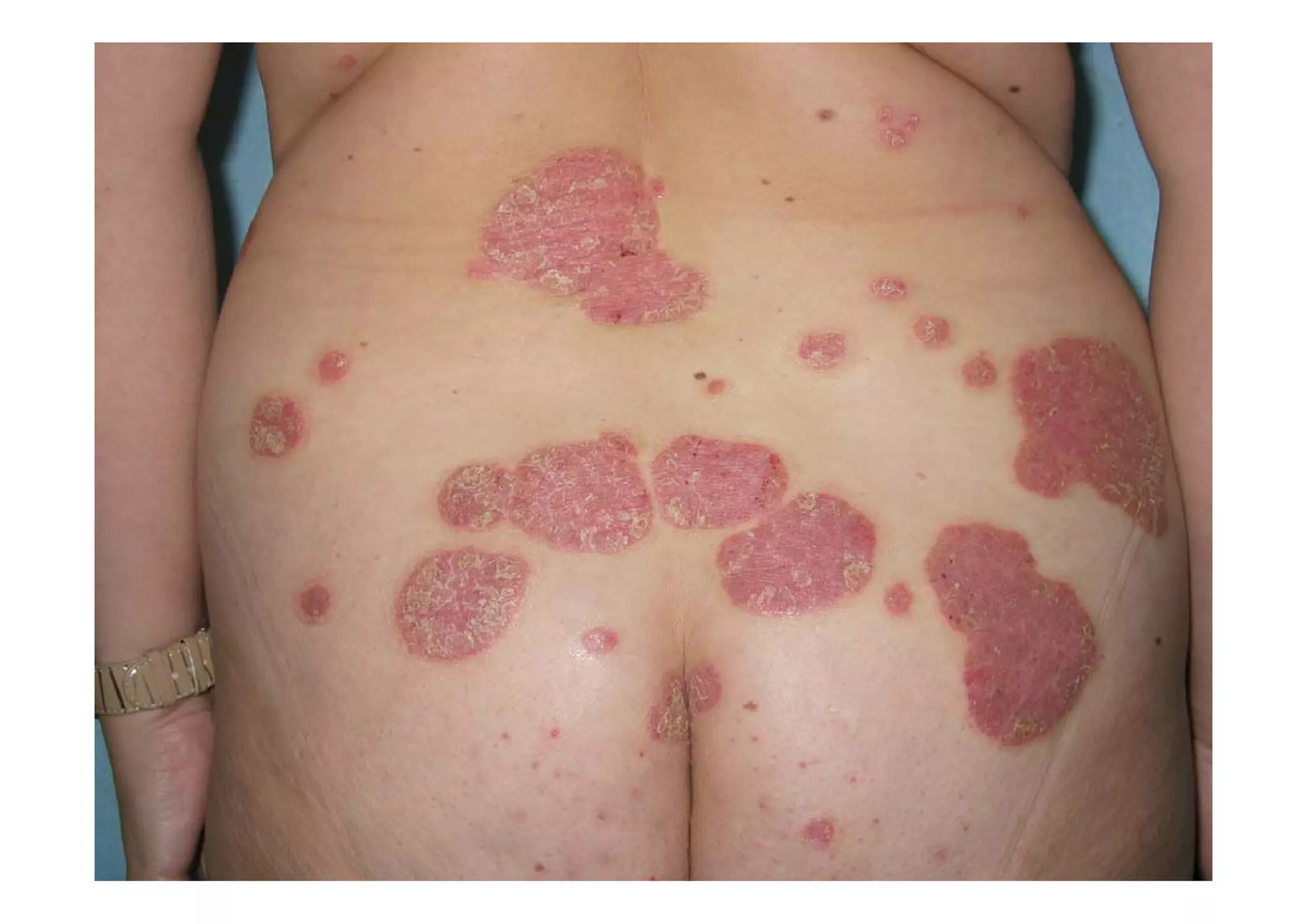 PSORIASIS EN PLACAS
 