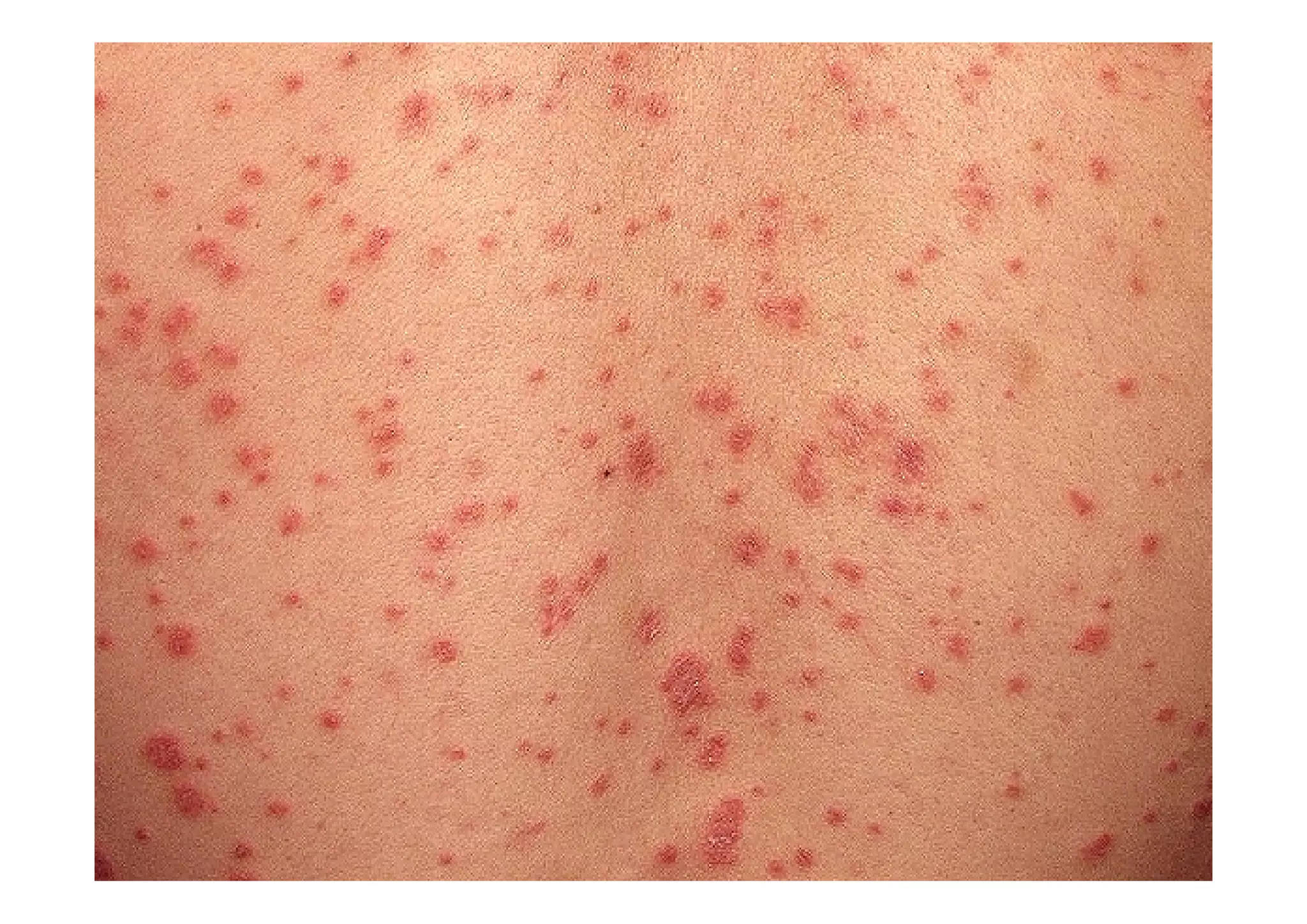 PSORIASIS EN GOTAS
 