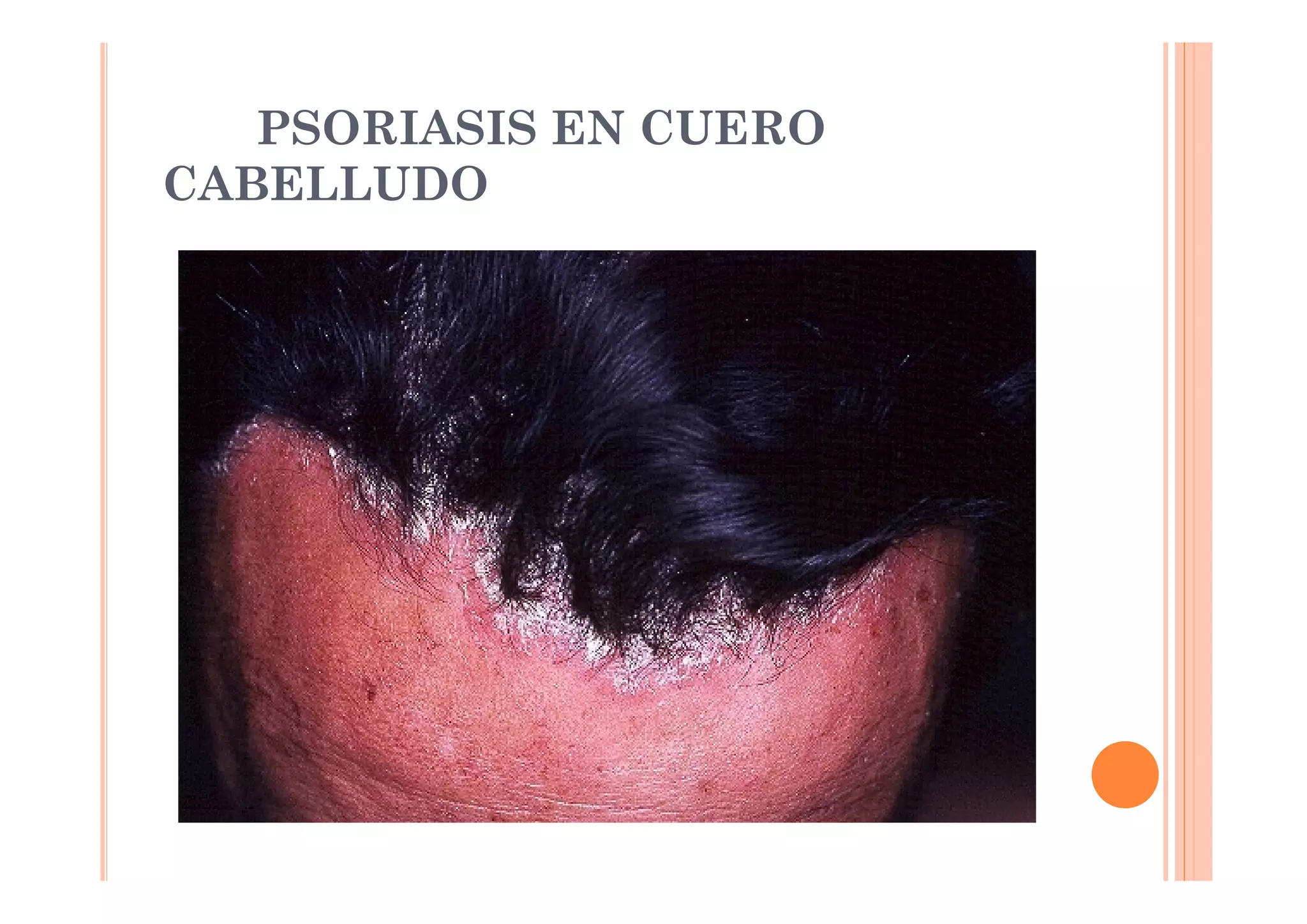 PSORIASIS EN CUERO
CABELLUDO
 
