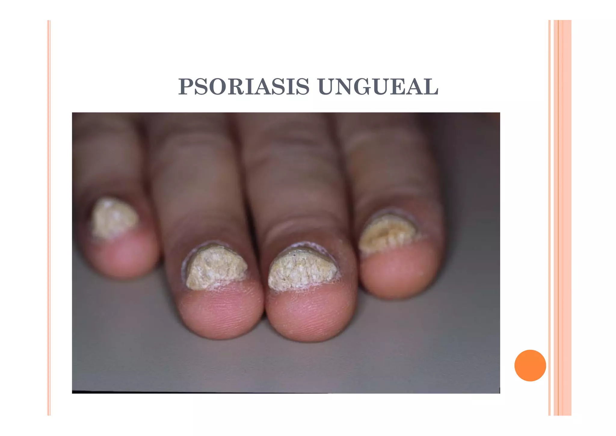 PSORIASIS UNGUEAL
 