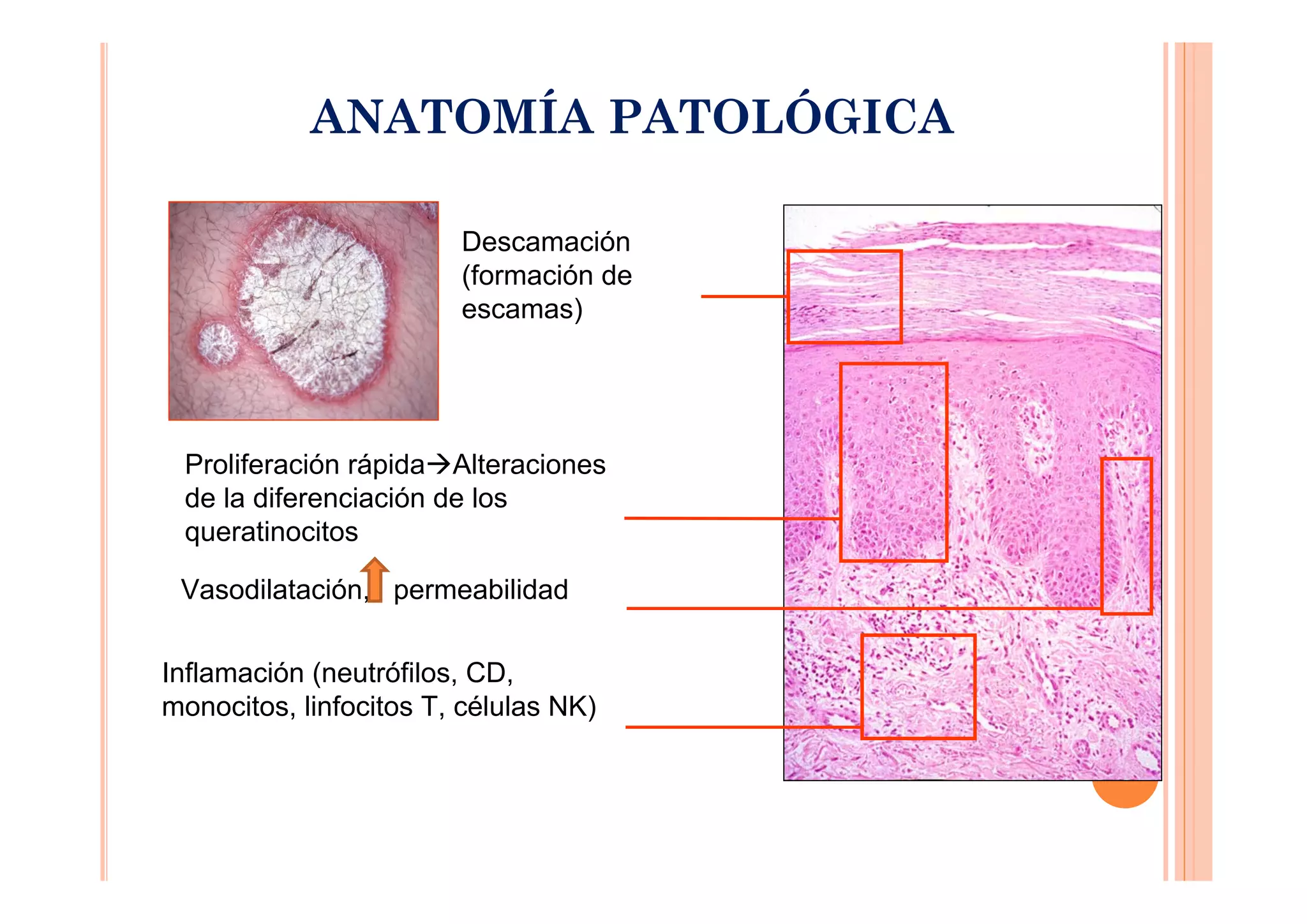 ANATOMÍA PATOLÓGICA

                        Descamación
                        (formación de
                        escamas)




 Proliferación rápida Alteraciones
 de la diferenciación de los
 queratinocitos

 Vasodilatación, permeabilidad

Inflamación (neutrófilos, CD,
monocitos, linfocitos T, células NK)
 