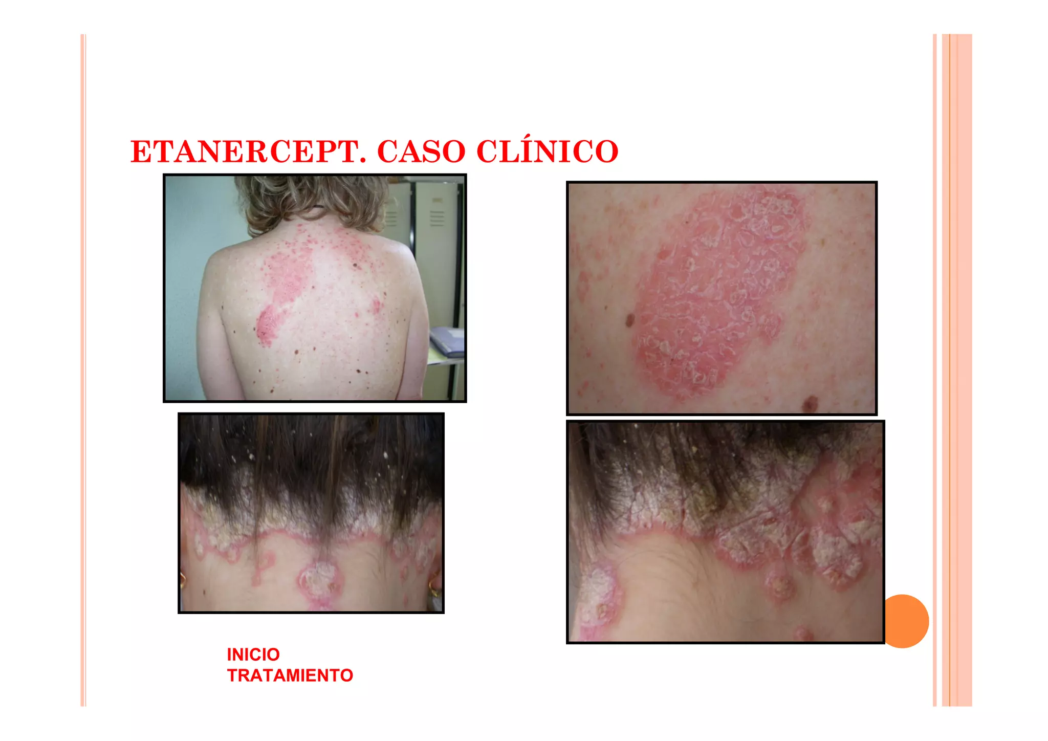 ETANERCEPT. CASO CLÍNICO




    INICIO
    TRATAMIENTO
 