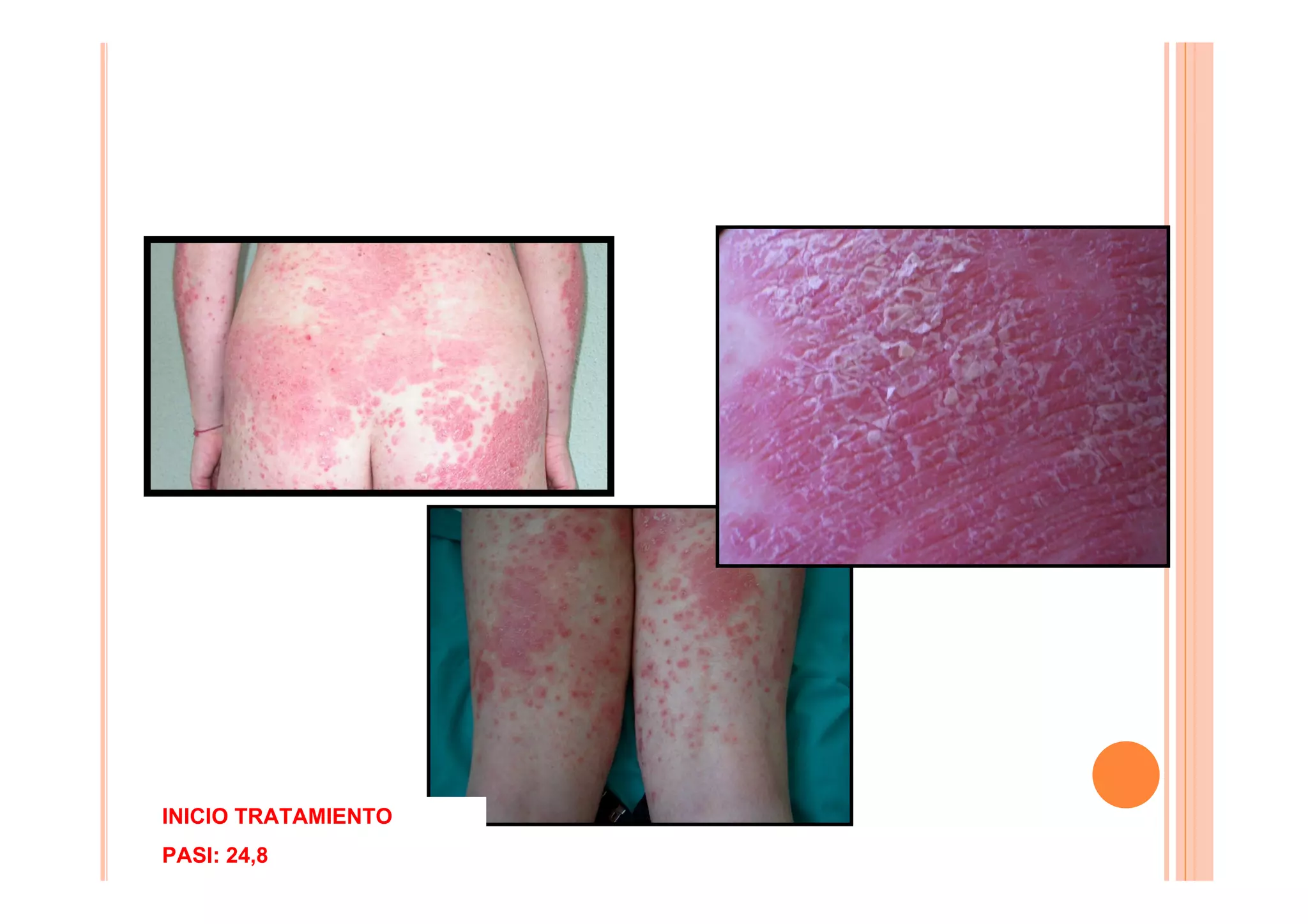 INICIO TRATAMIENTO
PASI: 24,8
 
